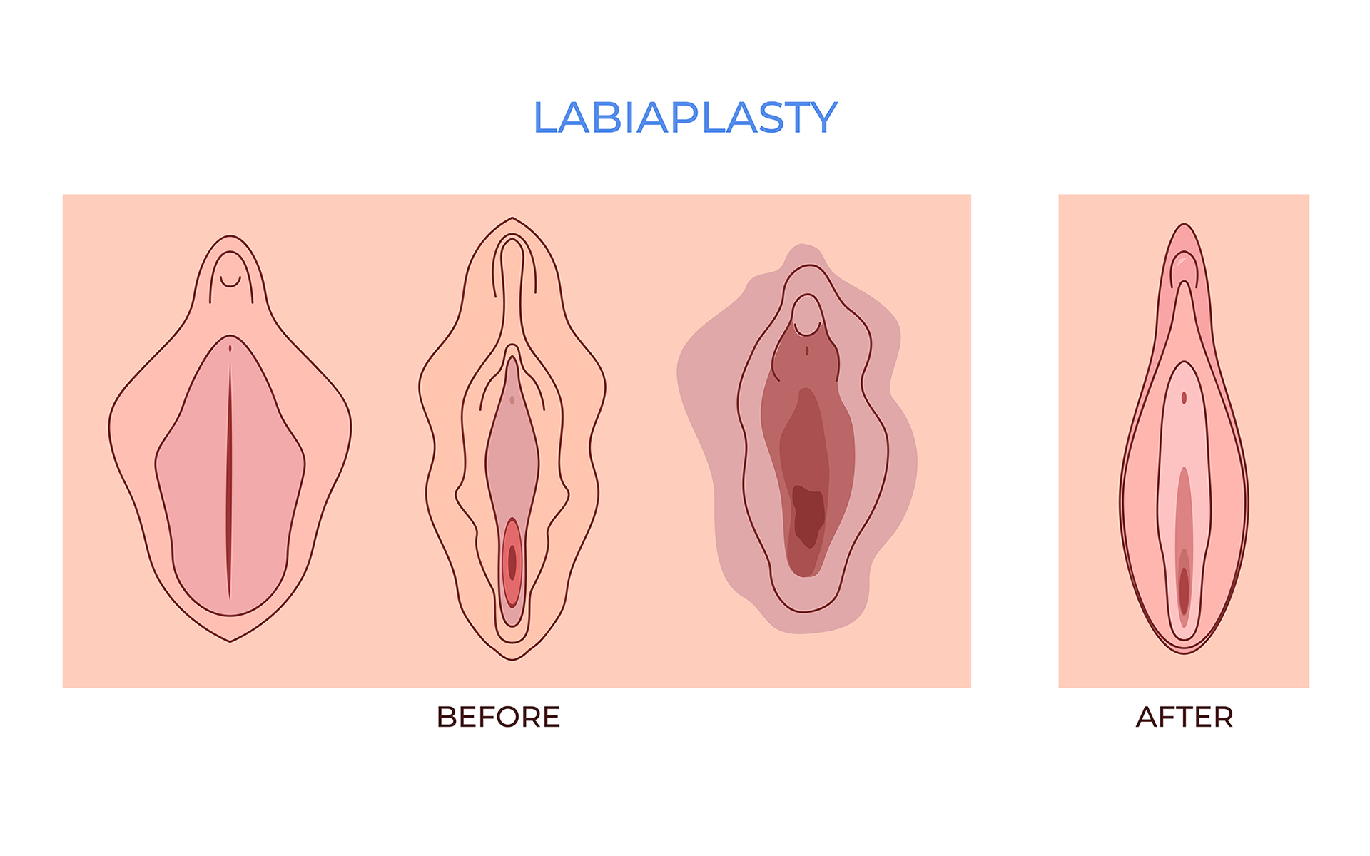 .Labiaplasty