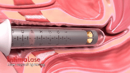 Urinary incontinence treatment
