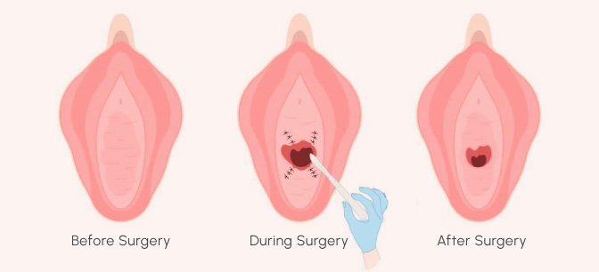 Hymenoplasty